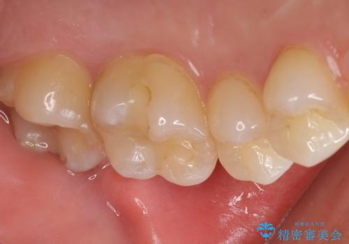 奥歯にフロスを通すと臭い 30代女性の治療前