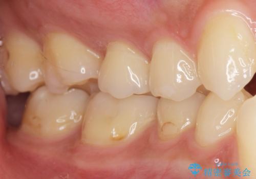 奥歯にフロスを通すと臭い 30代女性の治療前