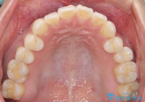 奥歯にフロスを通すと臭い 30代女性の治療前