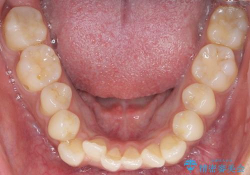 奥歯にフロスを通すと臭い 30代女性の治療前