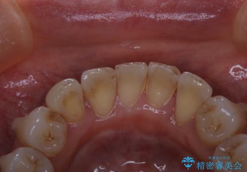 マウスピース矯正中にPMTC