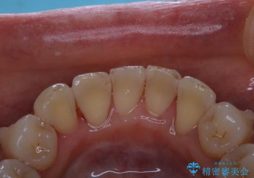 マウスピース矯正中にPMTCの治療後