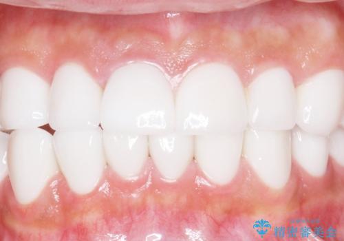 憧れの芸能人のような白い歯に 30代男性の治療後