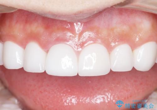 憧れの芸能人のような白い歯に 30代男性の治療後