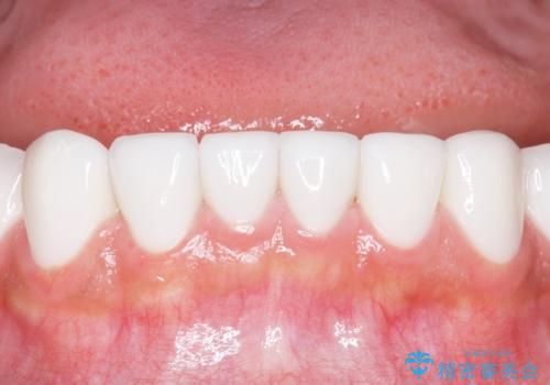 憧れの芸能人のような白い歯に 30代男性の治療後