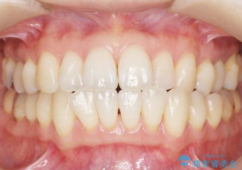 歯が欠けた セラミッククラウンで綺麗に 40代女性の治療後