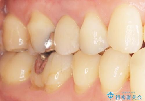 歯が欠けた セラミッククラウンで綺麗に 40代女性の治療後