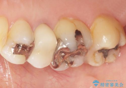 歯が欠けた セラミッククラウンで綺麗に 40代女性の治療後