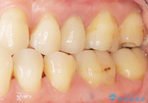 歯が欠けた セラミッククラウンで綺麗に 40代女性の症例 治療後