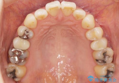 歯が欠けた セラミッククラウンで綺麗に 40代女性の治療後