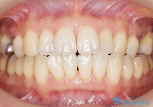 歯が欠けた セラミッククラウンで綺麗に 40代女性の治療中
