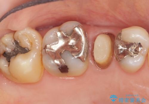 歯が欠けた セラミッククラウンで綺麗に 40代女性の治療中