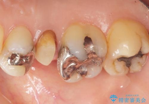 歯が欠けた セラミッククラウンで綺麗に 40代女性の治療中