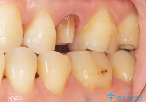 歯が欠けた セラミッククラウンで綺麗に 40代女性の治療中