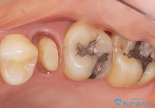 歯が欠けた セラミッククラウンで綺麗に 40代女性の治療中