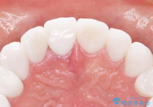 憧れの芸能人のような白い歯に 30代男性の治療後