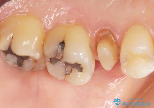 歯が欠けた セラミッククラウンで綺麗に 40代女性の治療中