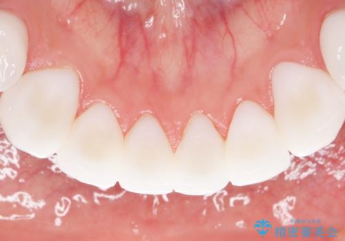 憧れの芸能人のような白い歯に 30代男性の治療後
