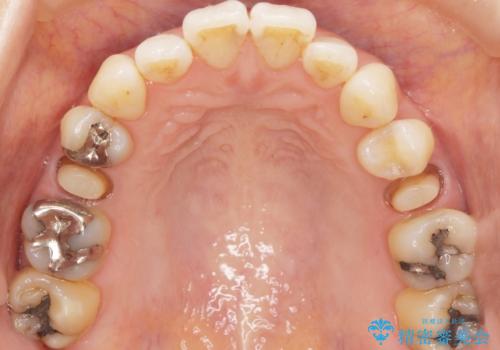 歯が欠けた セラミッククラウンで綺麗に 40代女性の治療中