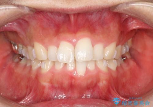 全体のガタガタをインビザラインできれいな歯並びへの治療中