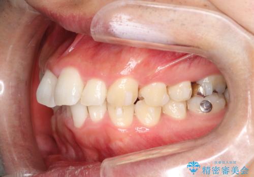 全体のガタガタをインビザラインできれいな歯並びへの治療中
