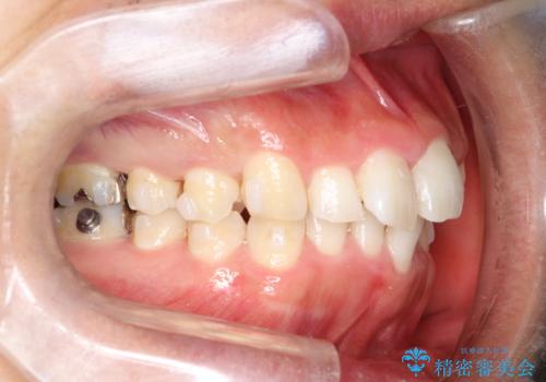 全体のガタガタをインビザラインできれいな歯並びへの治療中