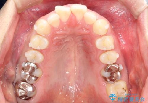 全体のガタガタをインビザラインできれいな歯並びへの治療中