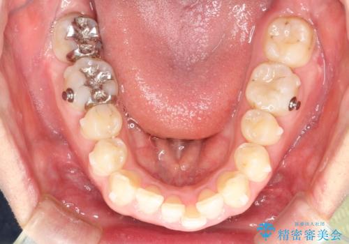 全体のガタガタをインビザラインできれいな歯並びへの治療中