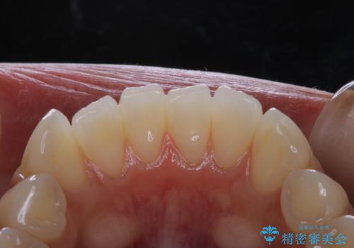 毎日のマスク着用により感じる口臭をPMTCで予防の治療前