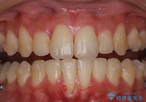 インビザラインでの矯正中に歯科医院でのクリーニングの治療前