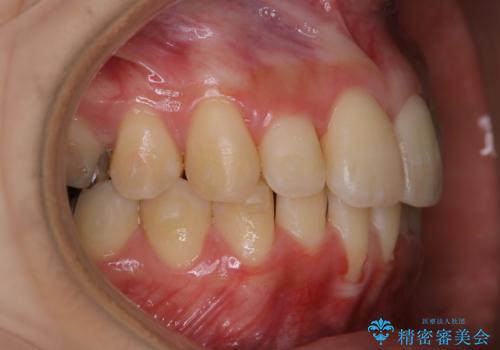 インビザラインでの矯正中に歯科医院でのクリーニングの治療前