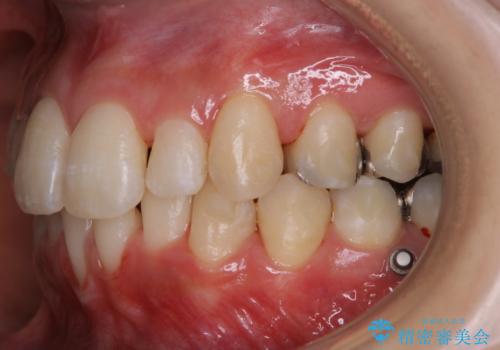 インビザラインでの矯正中に歯科医院でのクリーニングの治療後