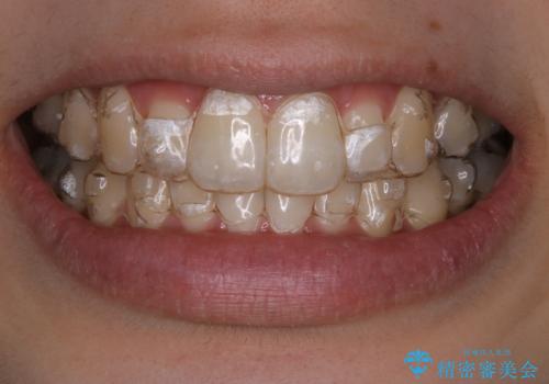 インビザラインでの矯正中に歯科医院でのクリーニング