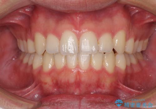狭い歯列と前歯のデコボコ インビザラインによる矯正治療の治療中