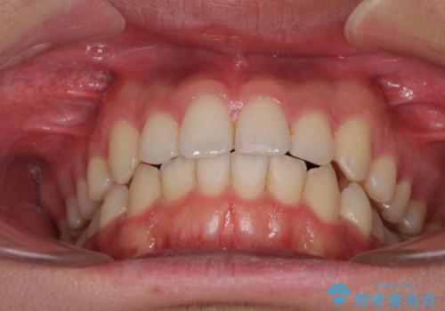 狭い歯列と前歯のデコボコ　インビザラインによる矯正治療の治療中