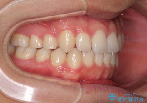 狭い歯列と前歯のデコボコ インビザラインによる矯正治療の治療中