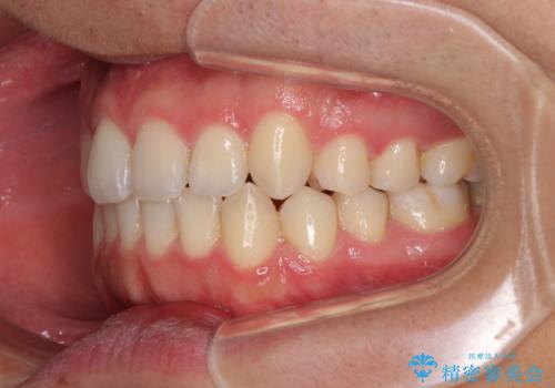 狭い歯列と前歯のデコボコ インビザラインによる矯正治療の治療中