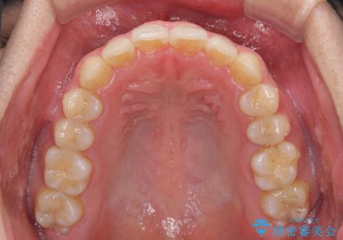 狭い歯列と前歯のデコボコ インビザラインによる矯正治療の治療中