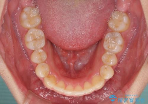 狭い歯列と前歯のデコボコ インビザラインによる矯正治療の治療中