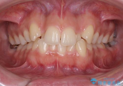 骨格的に左右にずれいている　前歯のデコボコをインビザラインで解消の症例 治療前