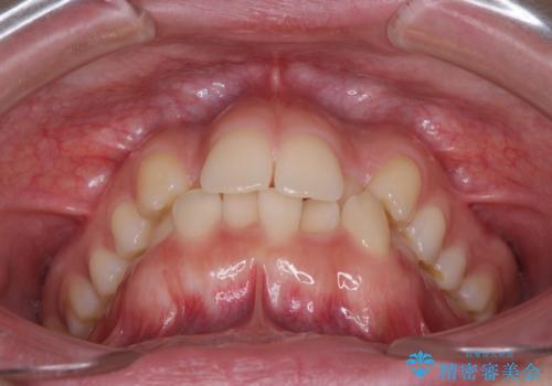 骨格的に左右にずれいている 前歯のデコボコをインビザラインで解消の治療前