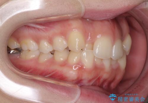 骨格的に左右にずれいている　前歯のデコボコをインビザラインで解消の治療前