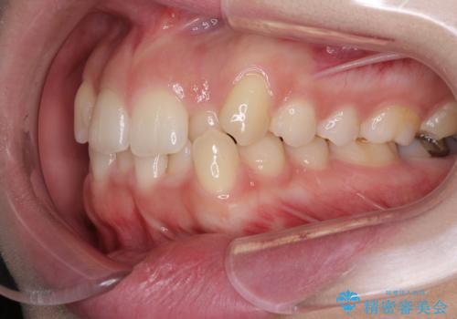 骨格的に左右にずれいている 前歯のデコボコをインビザラインで解消の治療前