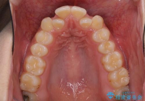 骨格的に左右にずれいている　前歯のデコボコをインビザラインで解消の治療前