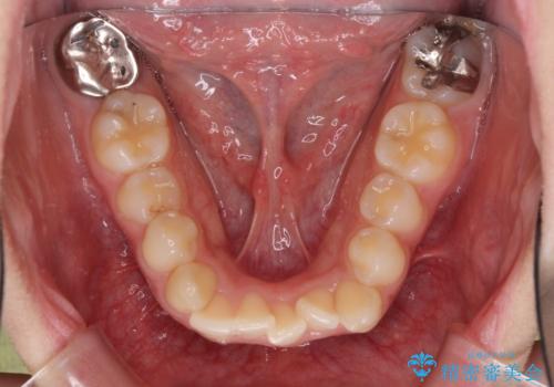 骨格的に左右にずれいている 前歯のデコボコをインビザラインで解消の治療前