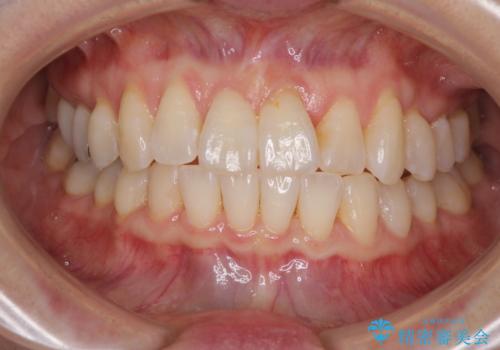 前歯のクロスバイト　インビザライン矯正で改善の治療中