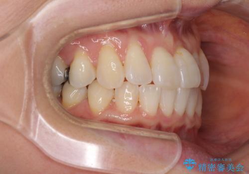 前歯のクロスバイト インビザライン矯正で改善の治療中