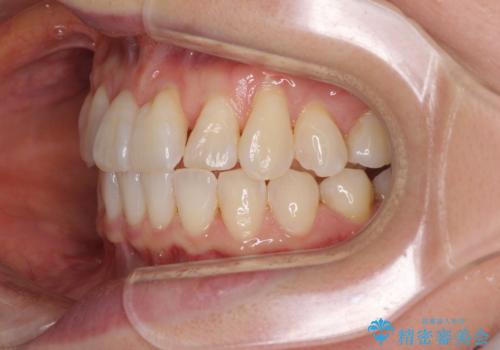 前歯のクロスバイト インビザライン矯正で改善の治療中