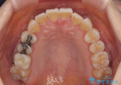 前歯のクロスバイト インビザライン矯正で改善の治療中