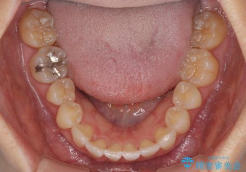 前歯のクロスバイト インビザライン矯正で改善の治療中